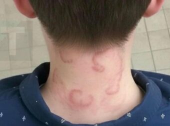 Ο 8χρονος γιος μου έχει αυτό εδώ και 2 μήνες συνεχόμενα και έχει χειροτερέψει από την πρώτη φορά που το είχε… Τι είναι;