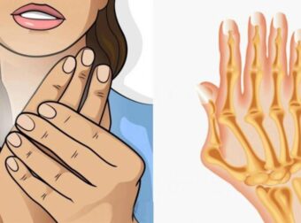 Ρευματοειδής αρθρίτιδα: Τα συνήθη συμπτώματα- Τι να τρώτε και τι να αποφεύγετε