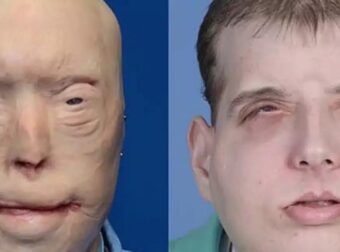 Ολική μεταμόσχευση προσώπου – Παραμορφωμένος πυροσβέστης απέκτησε νέα ζωή