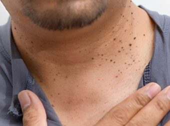 11 ύπουλα σημάδια υψηλού σακχάρου στο αίμα – Ποια είναι τα πιο συνηθισμένα