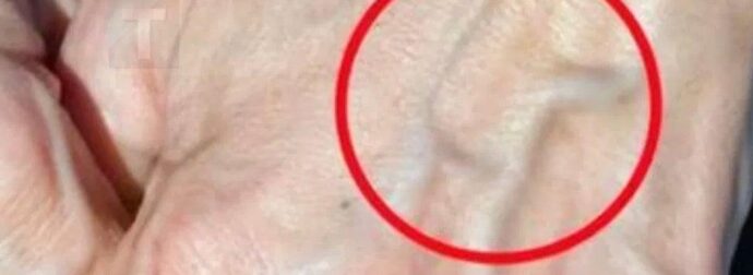 Πότε να ανησυχείτε για τις φλέβες που εμφανίζονται ξαφνικά