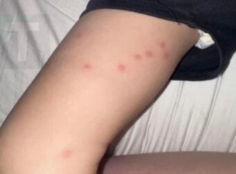 Το νήπιο μου ξύπνησε με αυτά τα εξογκώματα στο πάνω μέρος των μnρών του