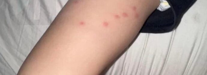 Το νήπιο μου ξύπνησε με αυτά τα εξογκώματα στο πάνω μέρος των μnρών του