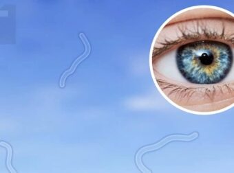 Οφθαλμίατρος αποκαλύπτει τι να κάνετε αν αρχίσετε να βλέπετε «μυγάκια»