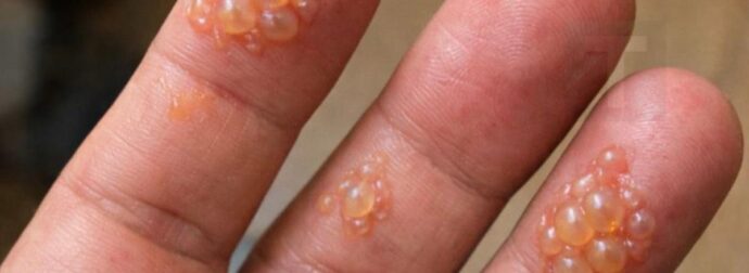 Τα δάχτυλα του συζύγου είναι καλυμμένα με αυτές τις μικροσκοπικές φουσκάλες νερού. Δεν μπορεί καν να πληκτρολογήσει για τη δουλειά