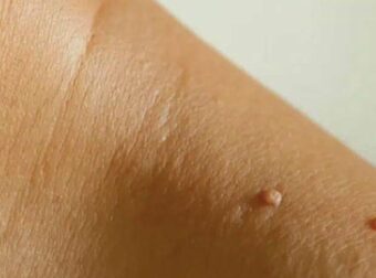 Γιατί εμφανίζονται σαρκώδεις ελιές στο λαιμό ή στις μασχάλες μου και πώς μπορώ να τις αφαιρέσω; Οι ειδικοί εξηγούν