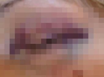 Λευκάδα: «Θα το ξαναέκανα και με μωβ μάτι» λέει η δασκάλα μετά τον άγριο ξυλοδαρμό