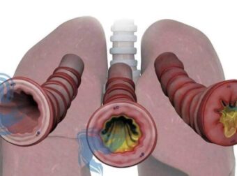 Πώς να απαλλαγείτε από τα φλέγματα και τη βλέννα στον λαιμό