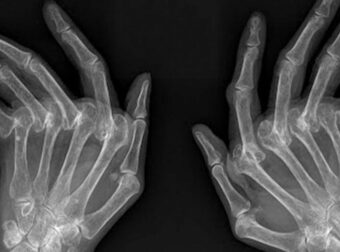 Ρευματοειδής αρθρίτιδα (ΡΑ): 12 συμπτώματα του αυτοάνοσου νοσήματος που πρέπει να ξέρεις