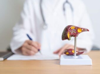 Λιπώδες ήπαρ: Αιτίες, συμπτώματα, θεραπεία και σπιτικές θεραπείες