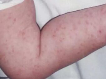 Μηνιγγίτιδα: Τα ύποπτα συμπτώματα που πρέπει να ανησυχήσουν τους γονείς