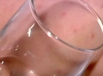 Το σημάδι στο δέρμα από μηνιγγίτιδα: Πώς γίνεται το «τεστ με το ποτήρι»