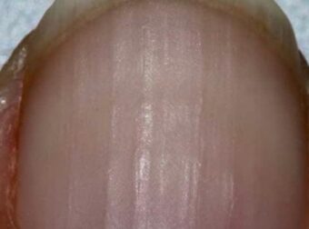 Αν παρατηρείτε ραβδώσεις στα νύχια σας, δείτε τι σημαίνουν