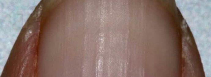 Αν παρατηρείτε ραβδώσεις στα νύχια σας, δείτε τι σημαίνουν