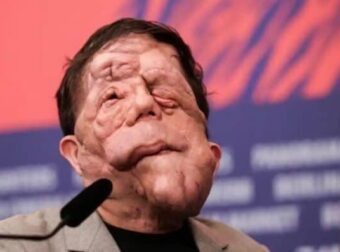 Χαμός στα Όσκαρ: Πασίγνωστος ηθοποιός εμφανίστηκε με αυτό το πρόσωπο και… πάγωσαν όλοι – Η σπάνια αρρώστια που τον «χτύπησε»