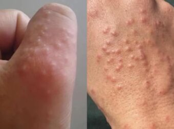 Μην αγνοείτε αυτές τις μικρές κόκκινες κηλίδες στο χέρι σας – Μπορεί να είναι σημαντικά προειδοποιητικά σημάδια