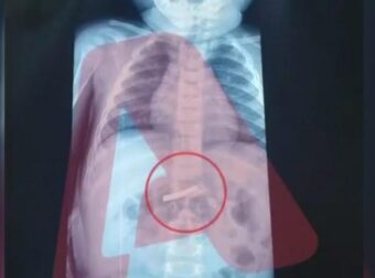 Στο νοσοκομείο Παίδων 3χρονο αγόρι – Τι σοκαριστικό κατάπιε 