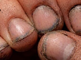 Τι πραγματικά λένε τα βρώμικα νύχια για έναν άνθρωπο;