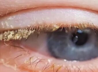 Οι άνθρωποι αναστατώθηκαν όταν συνειδητοποίησαν τι πραγματικά είναι η κίτρινη ουσία στα μάτια σου όταν ξυπνάς