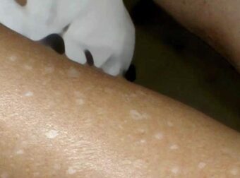 Γιατί εμφανίζονται μικρές λευκές κηλίδες στο δέρμα σας