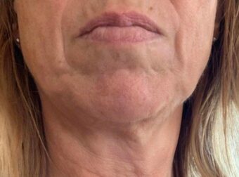 Ενδοκρινολόγος αποκαλύπτει τα δύο φαγητά που κάνουν το δέρμα να γερνά πιο γρήγορα