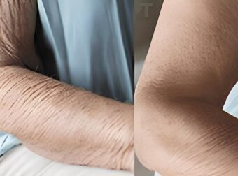 Πώς να φροντίσετε το δέρμα που γερνάει