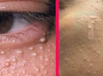 Γιατί εμφανίζονται μικρά λευκά σπυράκια στο πρόσωπο