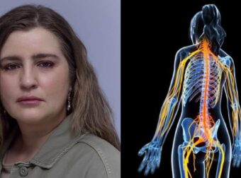 Τι είναι το αυτοάνοσο «ινομυαλγία» που έχει η Μαρία Κίτσου;