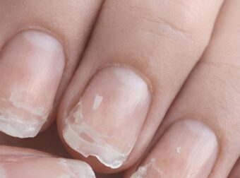 Τα νύχια σας σπάνε ή ξεφλουδίζουν συχνά; Να τι προσπαθεί να σας πει το σώμα σας