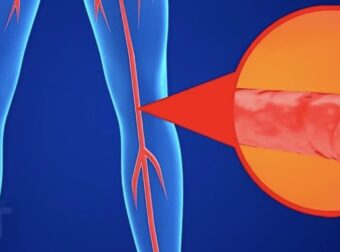 Χοληστερόλη: Τα σημάδια στα πόδια που μαρτυρούν ότι είναι στα ύψη