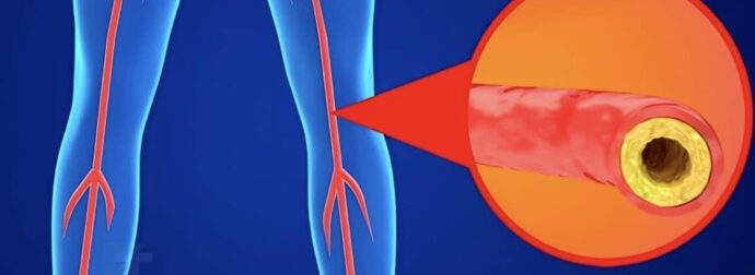 Χοληστερόλη: Τα σημάδια στα πόδια που μαρτυρούν ότι είναι στα ύψη