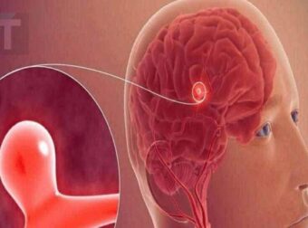 12 σημάδια που μπορεί να υποδηλώνουν ανεύρυσμα εγκεφάλου — Μην τα αγνοήσετε