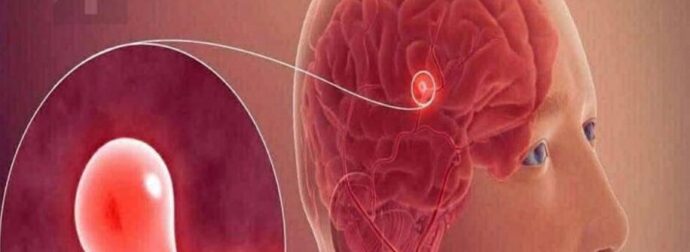 12 σημάδια που μπορεί να υποδηλώνουν ανεύρυσμα εγκεφάλου — Μην τα αγνοήσετε