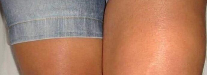 Γιατί το ένα γόνατο είναι πρησμένο αλλά όχι το άλλο;