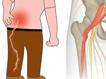 3 ασκήσεις για την ανακούφιση από τον ισχιαλγικό πόνο στο πόδι: πρακτικές και αποτελεσματικές