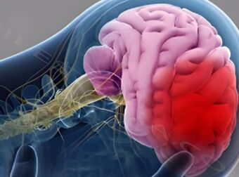 4 πράγματα που πολλοί κάνουν το πρωί και μπορεί να πάθουν εγκεφαλικό, όλες οι ηλικίες πρέπει να τα αποφεύγουν