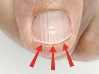 Αν έχετε αυτές τις γραμμές στα νύχια σας μετά τα 40, είναι ένα σαφές σημάδι ότι