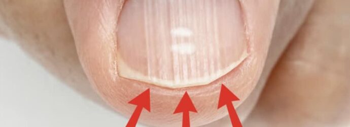 Αν έχετε αυτές τις γραμμές στα νύχια σας μετά τα 40, είναι ένα σαφές σημάδι ότι