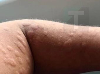 Τι είναι, πώς εμφανίζεται και πότε χρειάζεται ιατρική επίβλεψη