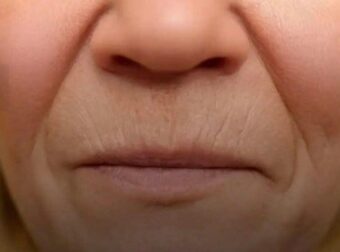 Tι πραγματικά λειτουργεί για τις ρυτίδες γύρω από το στόμα