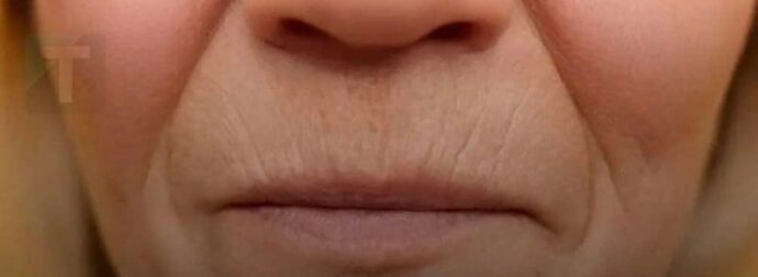 Tι πραγματικά λειτουργεί για τις ρυτίδες γύρω από το στόμα