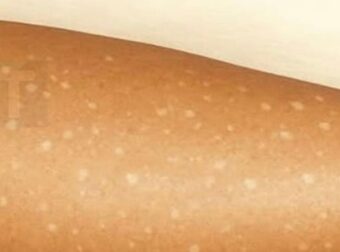 Λευκές κηλίδες στο δέρμα: Ποιες ελλείψεις βιταμινών μπορεί να είναι η αιτία;
